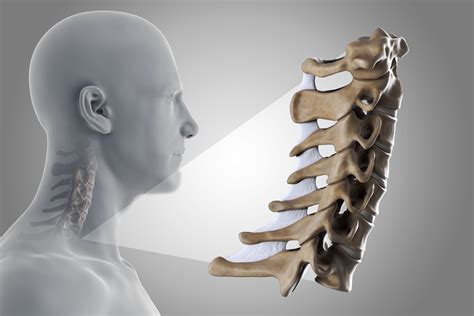 Should you Have Surgery for Cervical Radiculopathy?