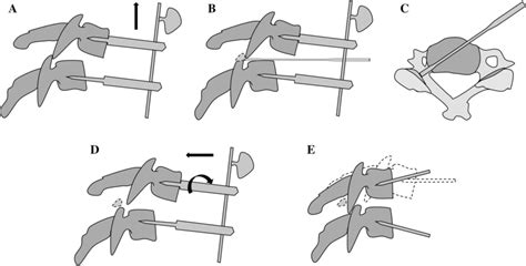 Anterior facetectomy technique of anterior reduction. a If facet... | Download Scientific Diagram