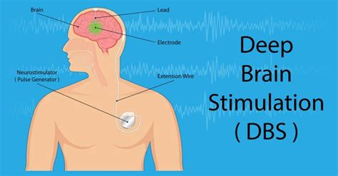 Dystonia: Causes, Symptoms & Treatment - Propel Physiotherapy