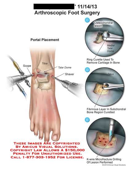 AMICUS Illustration of amicus,surgery,arthroscopic,footportal,tibia ...