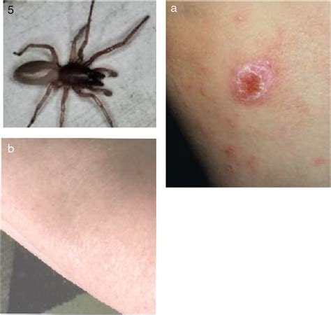 Wolf Spider Bite Treatment