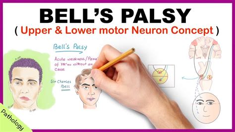 Bell Palsy Causes - Bell S Palsy The Canadian Association Of Optometrists / Bell's palsy is a ...