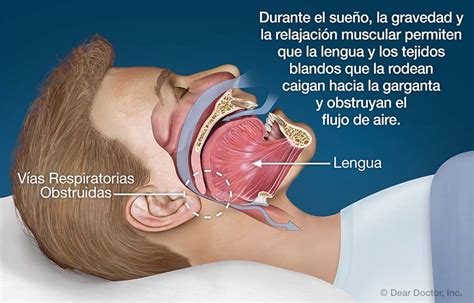 Apnea del Sueño | Clínica Dental Smile | Clínica Dental Smile