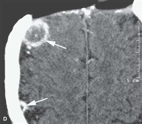 Benign and Malignant Neuroectodermal and Other Neurogenic Tumors ...