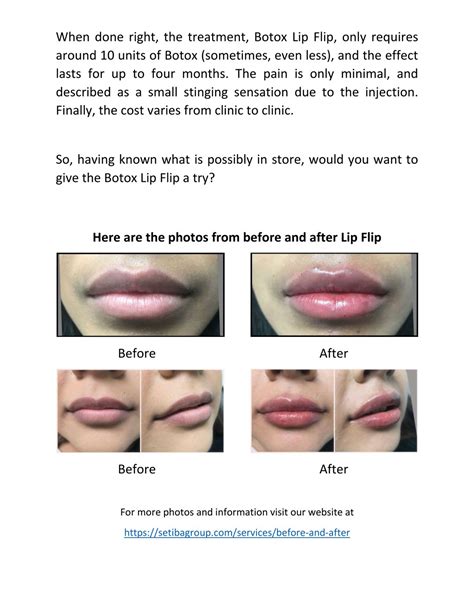 Lip Flip Botox Before And After Photos - Infoupdate.org