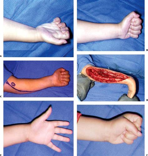 Compartment Syndrome in Children | Musculoskeletal Key