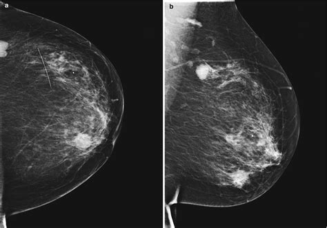 Mammography and Ultrasound Review | Radiology Key