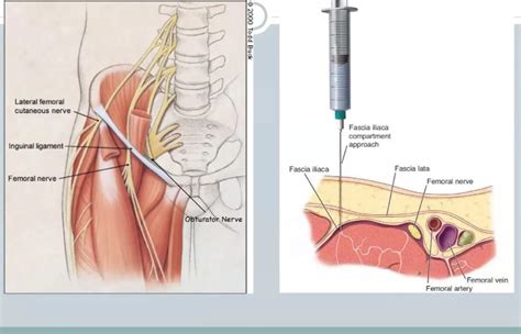 Fascia Iliaca Compartment Block — Downeast Emergency Medicine