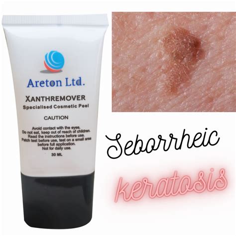 Glycolic Acid Peel Seborrheic keratosis Removal, Dark Spot, Age Spot - Keratosis | eBay