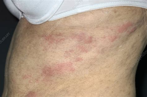 Shingles rash in leukaemia patient - Stock Image - M260/0421 - Science ...