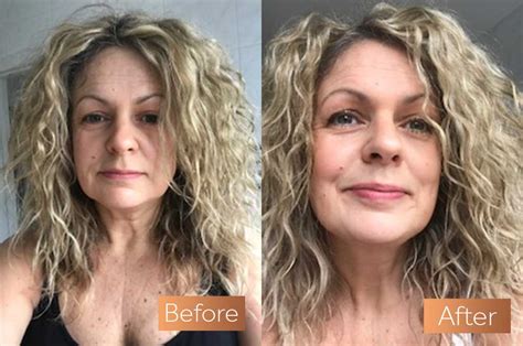 Absolute Collagen Before and After Pictures | Incredible Results – Absolute Collagen Ireland