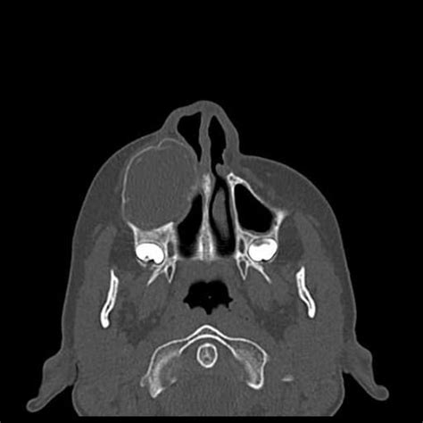 Maxillary odontogenic keratocyst | Radiology Case | Radiopaedia.org ...