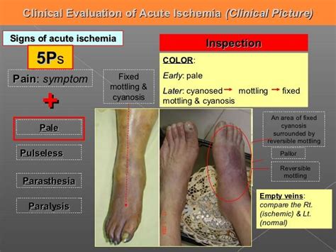 MEDICAL SCHOOL: ACUTE LIMB ISCHEMIA,MANAGEMENT | Limb, Medical, Management