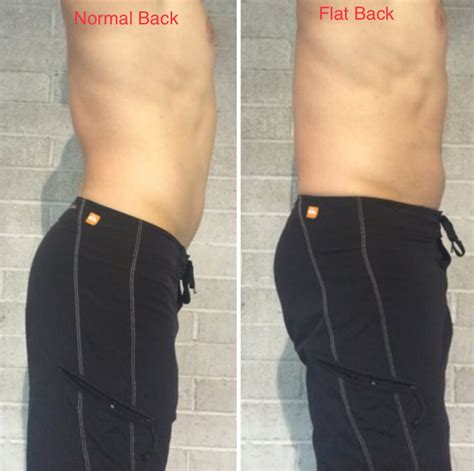 FLAT BACK HOW TO CORRECT ? | TREATMENT, EXERCİSE