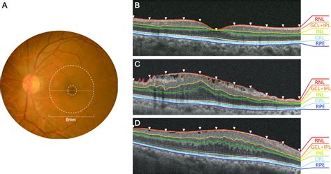 Images of fundus color and SD-OCT results of manual segmentation of ...