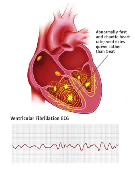 Cpr Test / Quiz & Worksheet - Cardiopulmonary Resuscitation (CPR ...