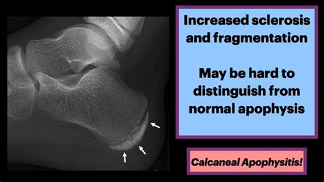 Calcaneal Apophysitis #MSK #Radiology #Orthopedics - YouTube