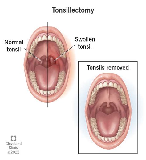 Healthy Tonsils