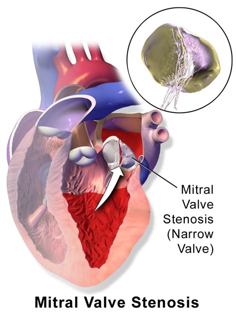 Mitral valve stenosis