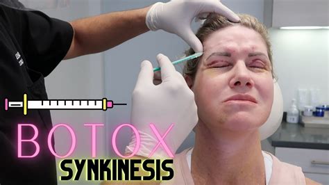 Botox for Synkinesis | How to cure synkinesis in less then 5 minutes ...