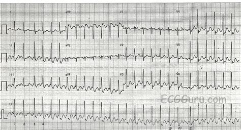 Atrial Flutter With 2:1 Conduction | ECG Guru - Instructor Resources