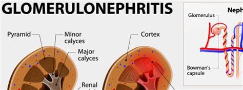 Glomerulonephritis: Causes, Symptoms and Treatment