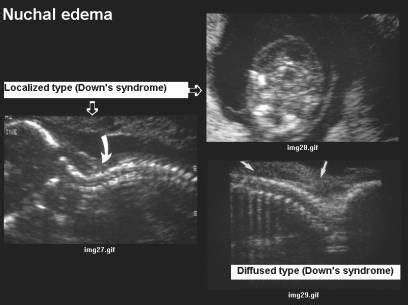 Down Syndrome Markers At 20 Week Ultrasound - Quotes Welcome