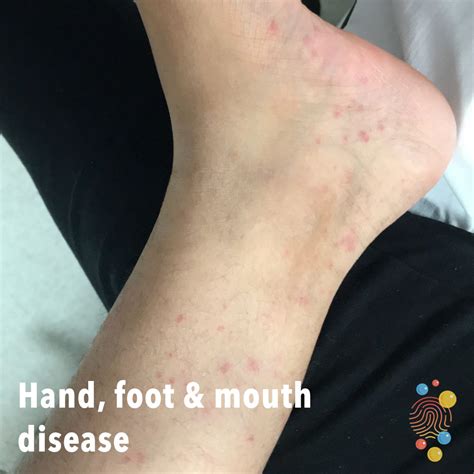 Hand Foot And Mouth Rash On Back Clearance | emergencydentistry.com