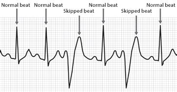 Erratic Heartbeat