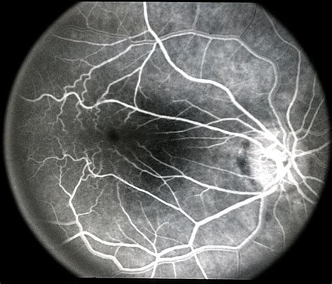 Macular Pucker - Retina Image Bank