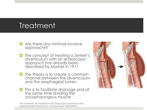 PPT - The Management of Zenker's Diverticulum PowerPoint Presentation, free download - ID:5244774