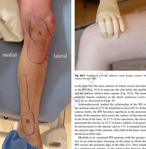 3 Pattern of pain in a patient with proximal saphenous entrapment (a)... | Download Scientific ...