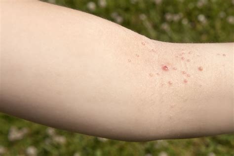 15 Common Skin Rashes in Children: Types and Causes