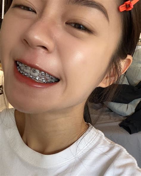 Pin by Shrood Burgos on Braces | Braces girls, Braces tips, Dental braces colors