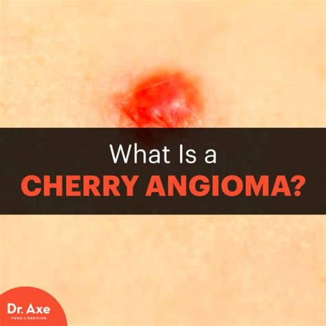 Cherry Angioma Risk Factors, Symptoms & Natural Treatments - Dr. Axe