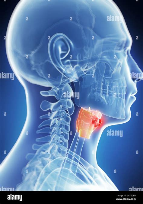 Larynx cancer hi-res stock photography and images - Alamy