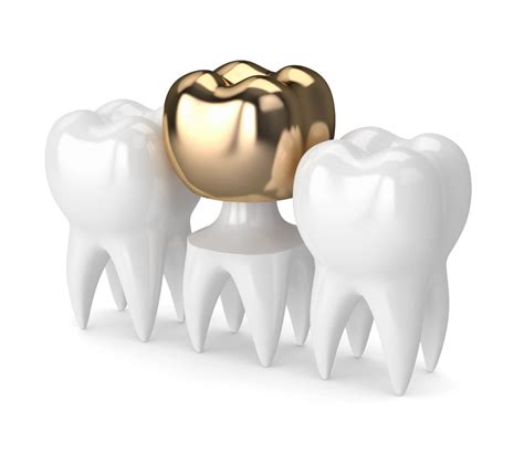 Gold Crown Tooth - rockville-all-smiles-dentistry.com