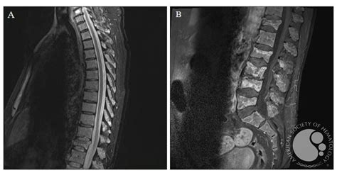 Multiple myeloma - MRI