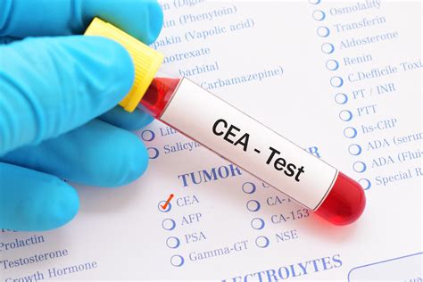 Understanding The CEA Test in Colon Cancer - CancerConnect