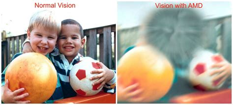 Macular Degeneration, Everything You Need To Know