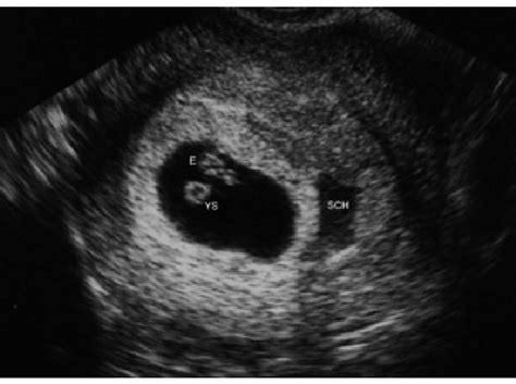 Subchorionic hemorrhage (SCH) appears as a sonolucent area adjacent to... | Download Scientific ...