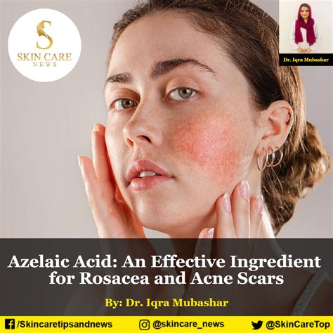 Azelaic Acid: An Effective Ingredient for Rosacea and Acne Scars