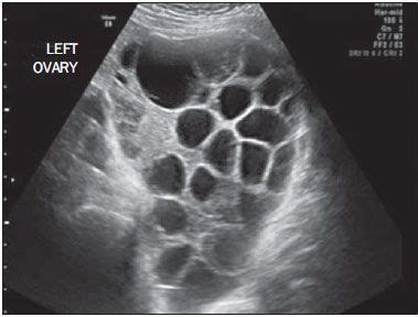 Pelvic ultrasound showing a massive theca lutein cyst in a patient with ...