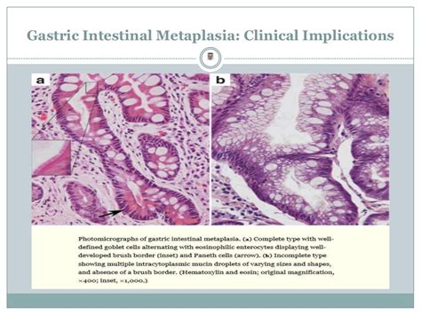 Gastric Intestinal Metaplasia - Clinical Implications