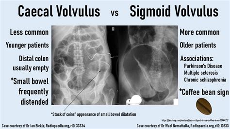 Sigmoid Volvulus