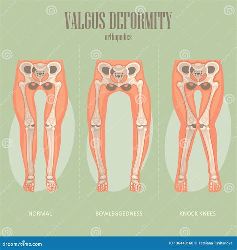 Valgus Deformity. Vector Medical Poster Stock Vector - Illustration of heel, orthopedic: 136443160