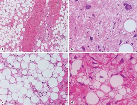 liposarcoma vs lipoma - pictures, photos