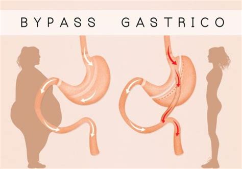 5 Types of Weight Loss Surgeries You Should Know