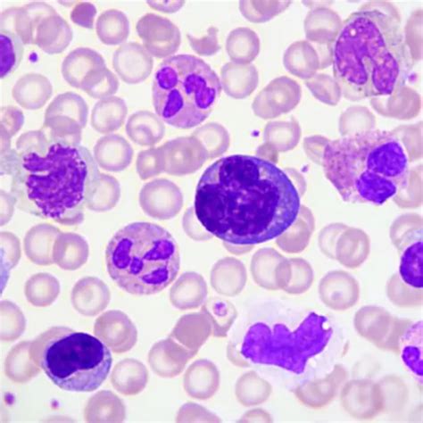 Blood Picture; Peripheral Blood Smear Examination Test In Delhi, India ...