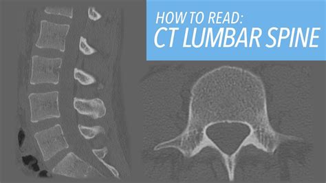 How to Read a CT of the Lumbar Spine: A Beginner's Approach - YouTube